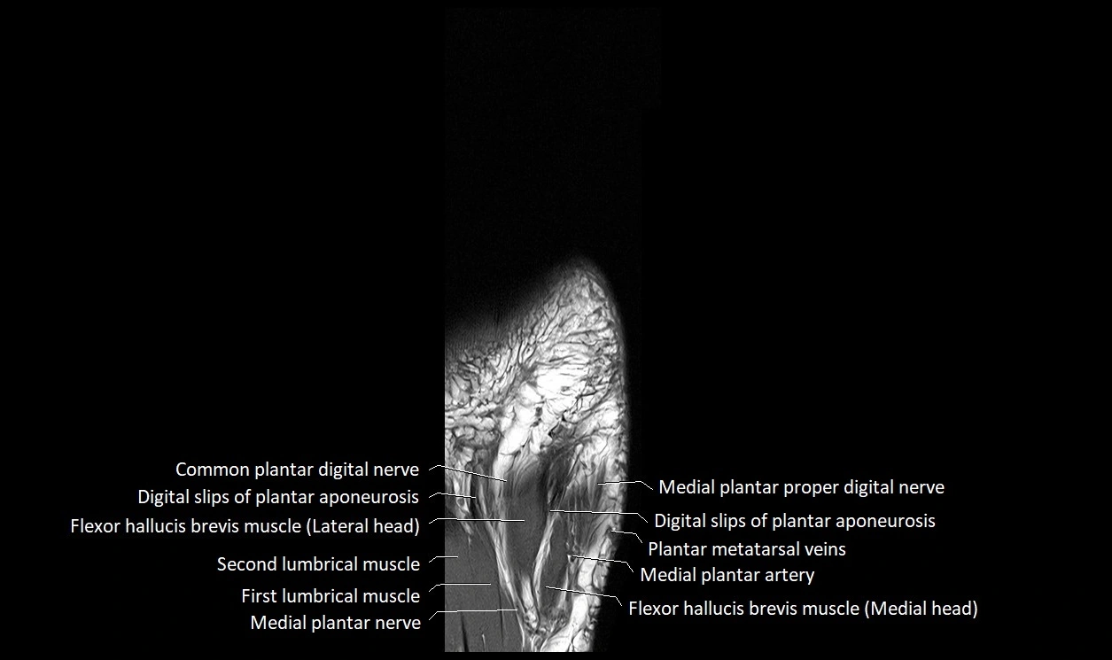 Great Toe micro anatomy MRI axial cross sectional 3T image 26.webp